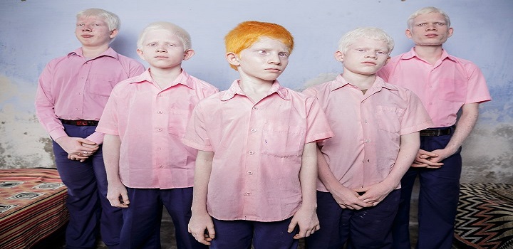 Lei semana do albinismo