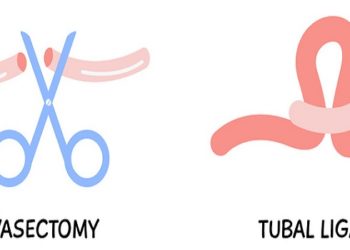 Vasectomy. Male or female sterilization concept. Tubal ligation colored flat style icons. Women or man surgical permanent birth control methods. Surgery procedure. Vector elements isolated on white