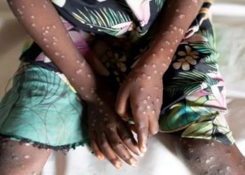 SURTO GLOBAL DE MPOX