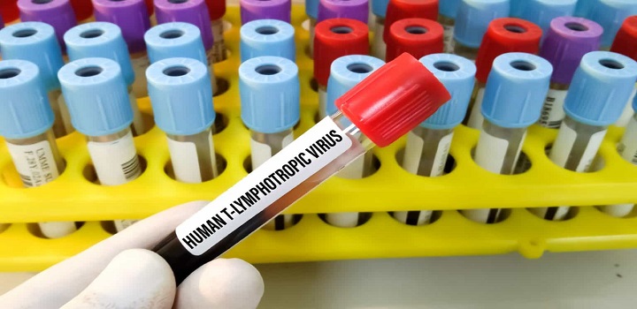 HTLV: conheça o primo distante do HIV e os seus perigos para a saúde