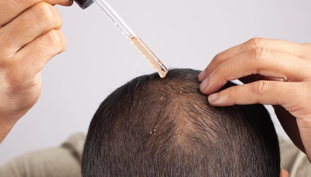 Agência retira do mercado itens sem autorização que induziam o consumidor ao erro ao mencionar minoxidil nas embalagens.