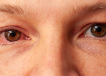 Conjuntivite provoca olhos vermelhos, secreção e coceira. Confira sintomas, causas e cuidados para prevenção e tratamento.