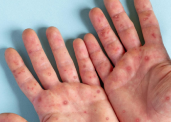 Mpox continua sendo monitorada no Brasil em 2026. Saiba onde há casos, sintomas da doença e recomendações das autoridades de saúde.