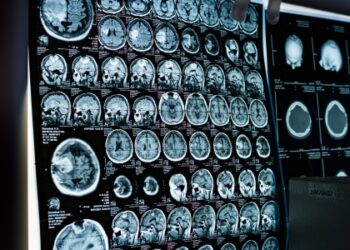 União Europeia avalia liberar primeiro tratamento direcionado para glioma pediátrico