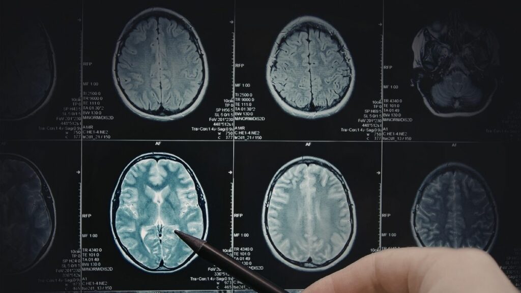 Hormônios masculinos podem estar ligados a câncer cerebral pediátrico.