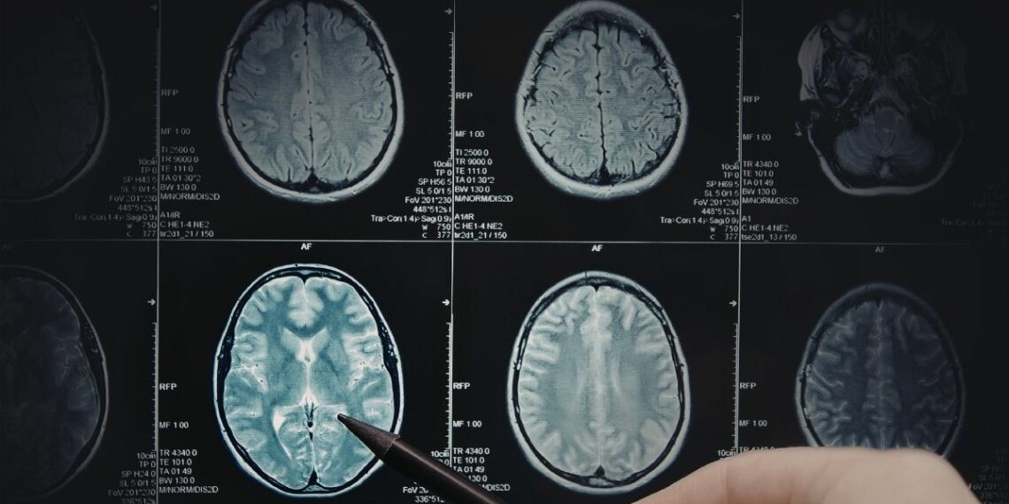 Hormônios masculinos podem estar ligados a câncer cerebral pediátrico.