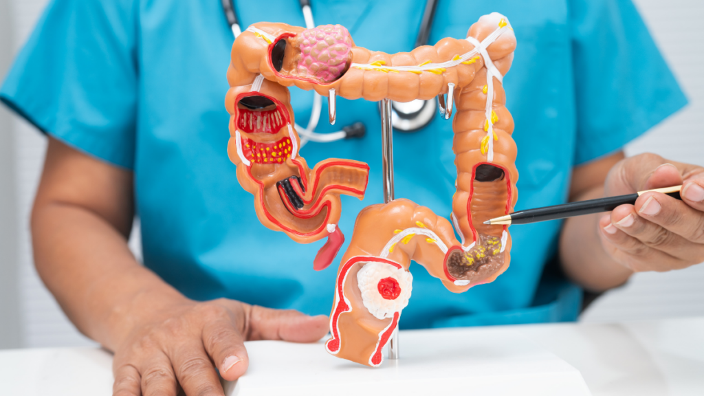 Ministério da Saúde anuncia teste para triagem do câncer de intestino