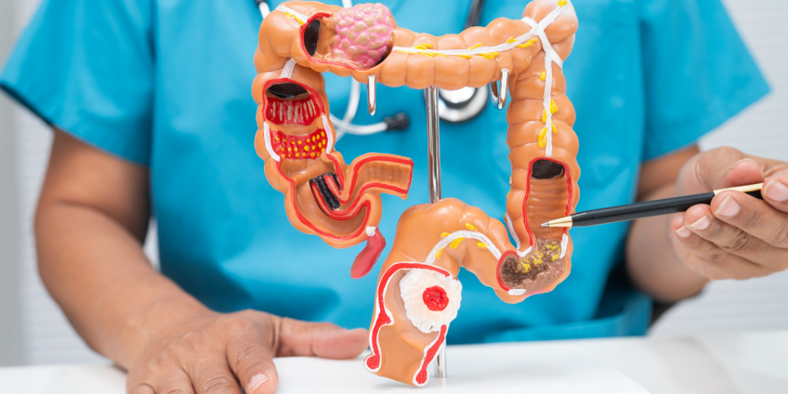 Ministério da Saúde anuncia teste para triagem do câncer de intestino