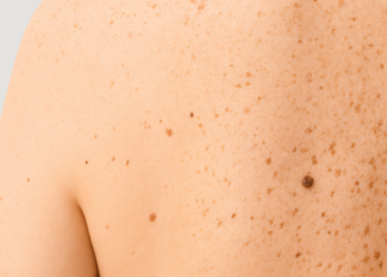 Pesquisa da Unicamp testa adesivo contra câncer de pele não melanoma. Tratamento pode reduzir cirurgias e preservar áreas sensíveis como nariz e lábios.