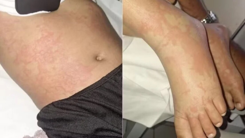 Menina internada em Natal após sintomas graves pode ter relação com detergente citado em alerta sanitário.