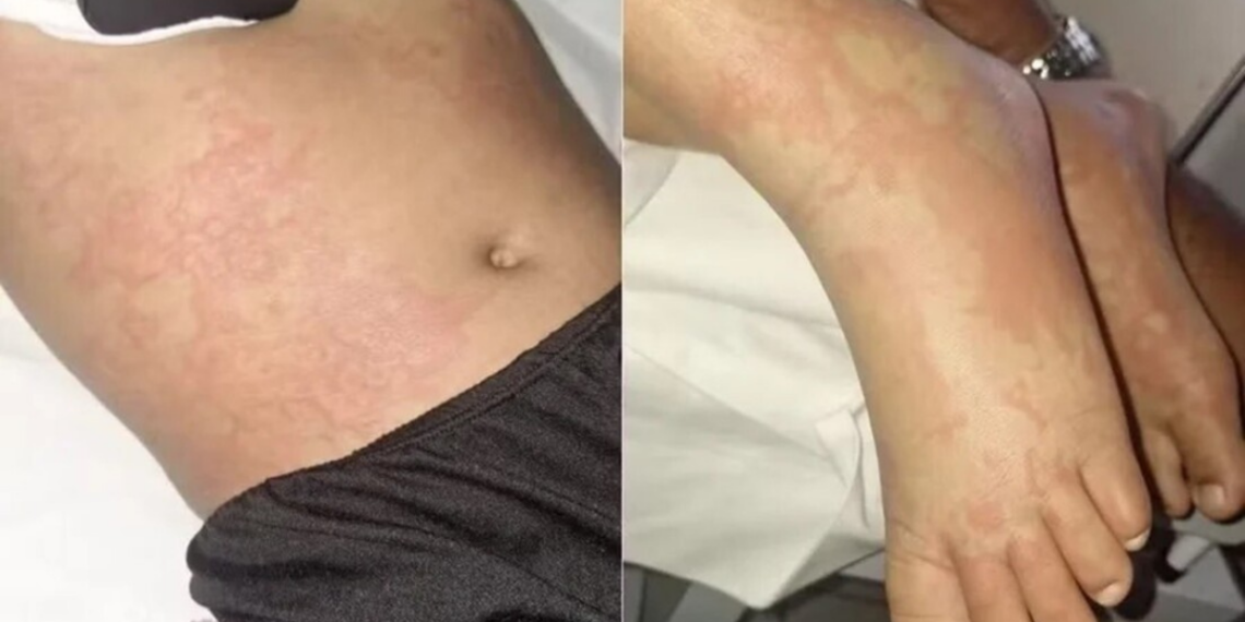 Menina internada em Natal após sintomas graves pode ter relação com detergente citado em alerta sanitário.