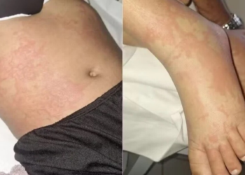 Menina internada em Natal após sintomas graves pode ter relação com detergente citado em alerta sanitário.