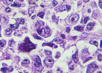 Pesquisa do Into e do INCA investiga células-tronco tumorais no osteossarcoma infantil para melhorar a resposta à quimioterapia e reduzir amputações.