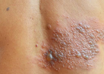 Proposta no Senado quer incluir vacina contra herpes-zóster no SUS para maiores de 50 anos e adultos com condições que afetem a imunidade.