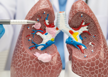 Estudo preliminar encontrou maior quantidade de microplásticos em pacientes com câncer de pulmão, mas não comprovou relação de causa e efeito.